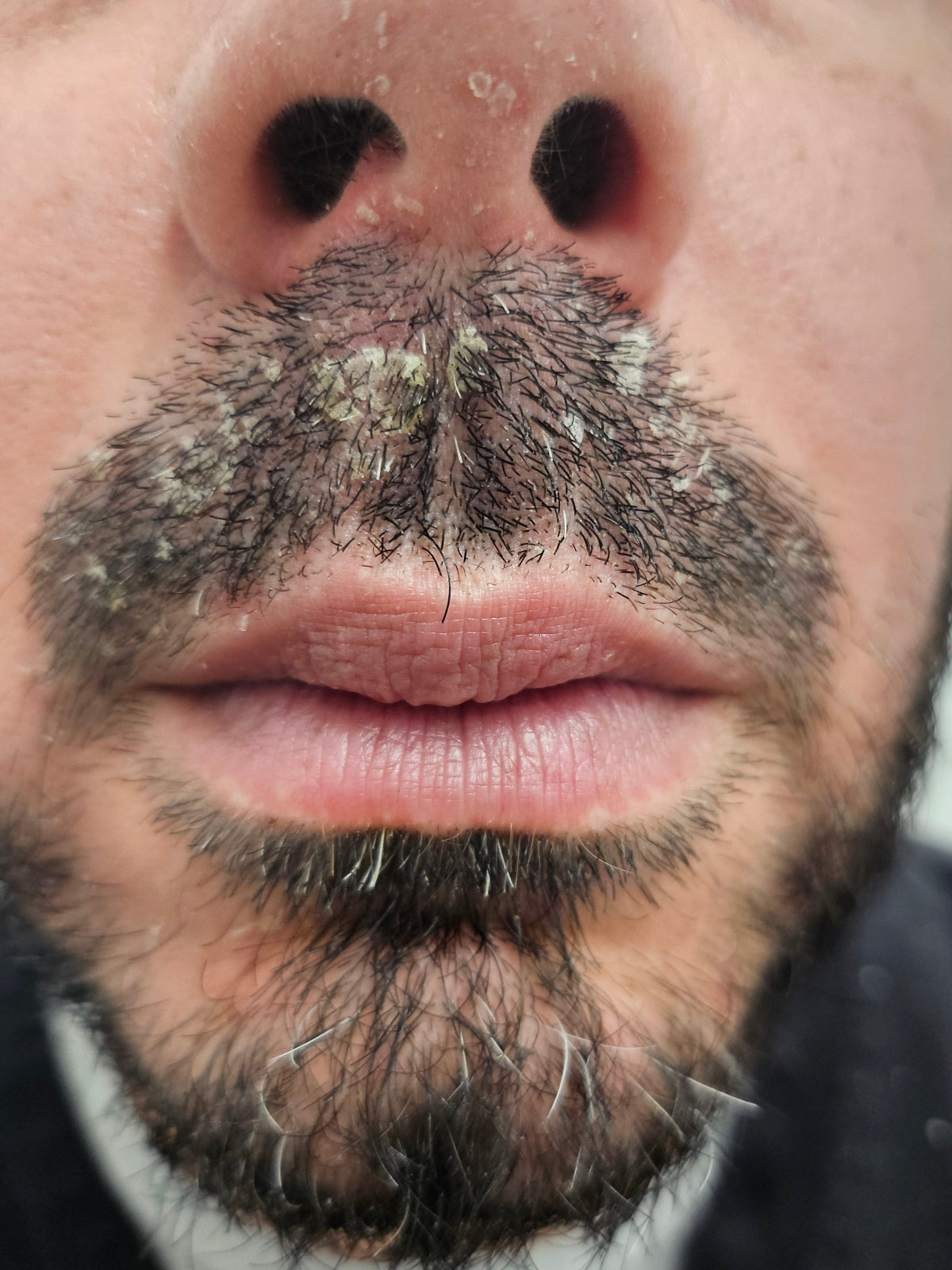 BEFORE: chin scaling and redness from seborrheic dermatitis prior to Epicderma treatment