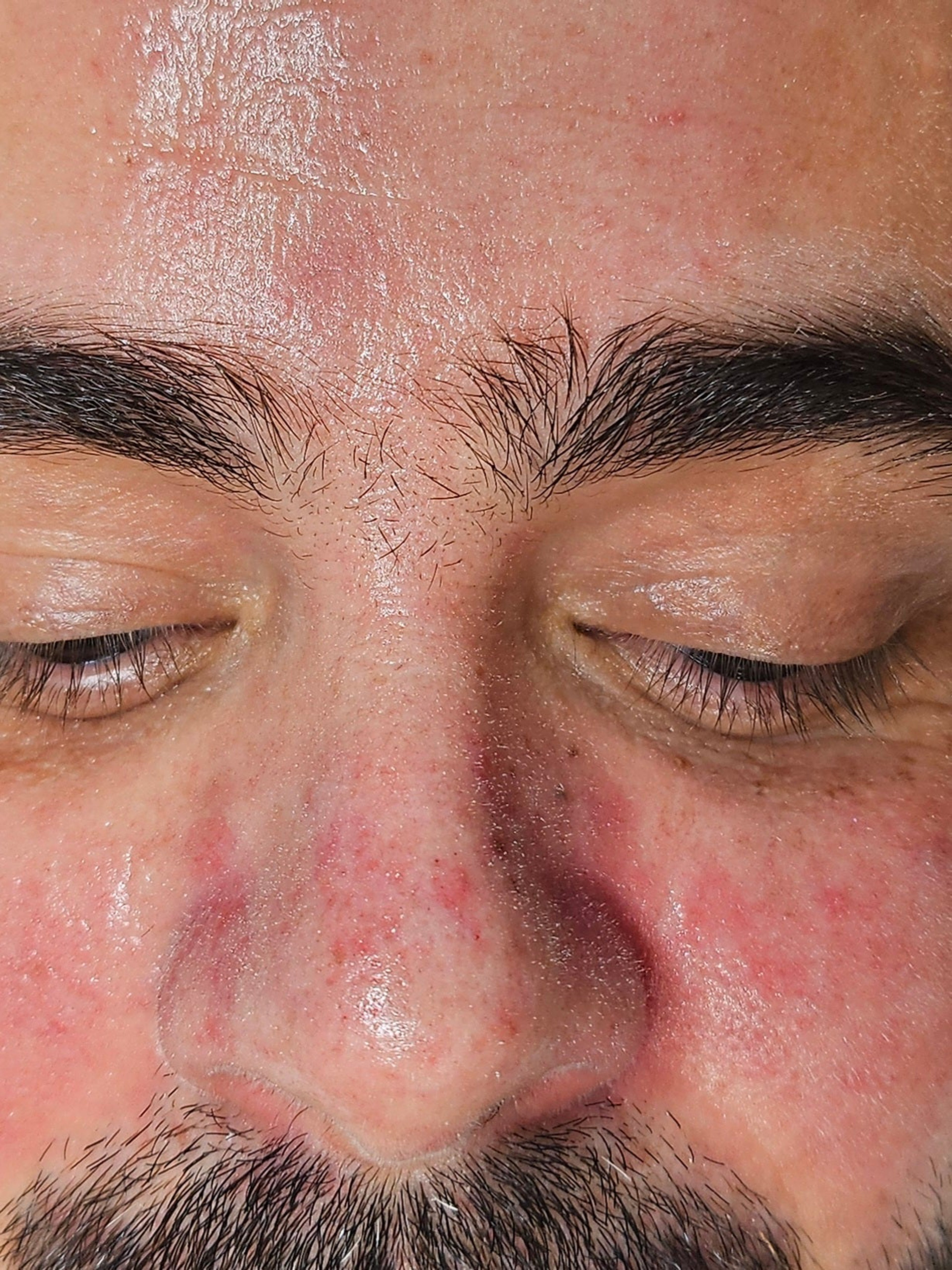 Close-up of inflamed eyelids from seborrheic dermatitis before Epicderma