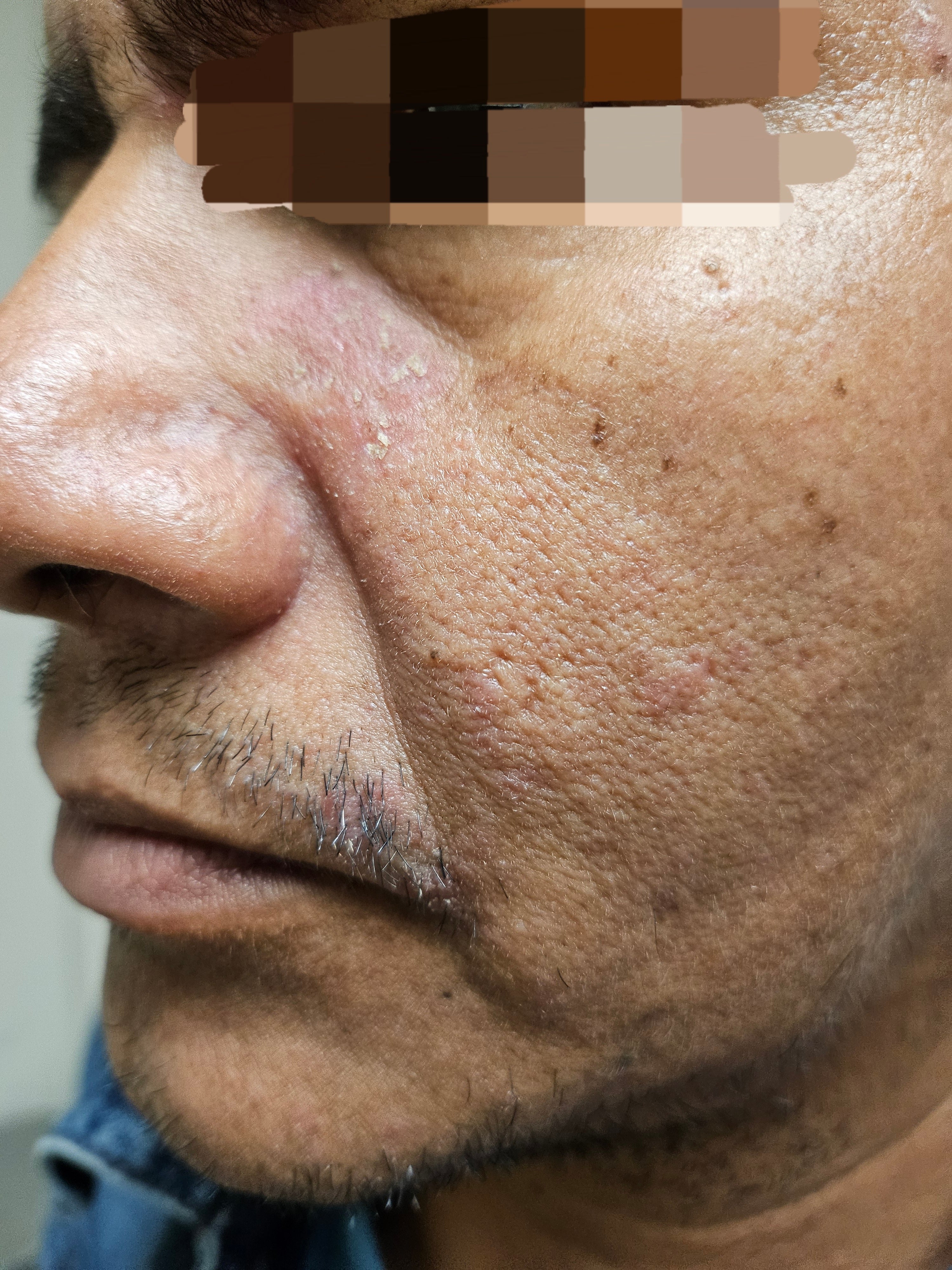 PROGRESS: chin flaking reduced mid-treatment with Epicderma
