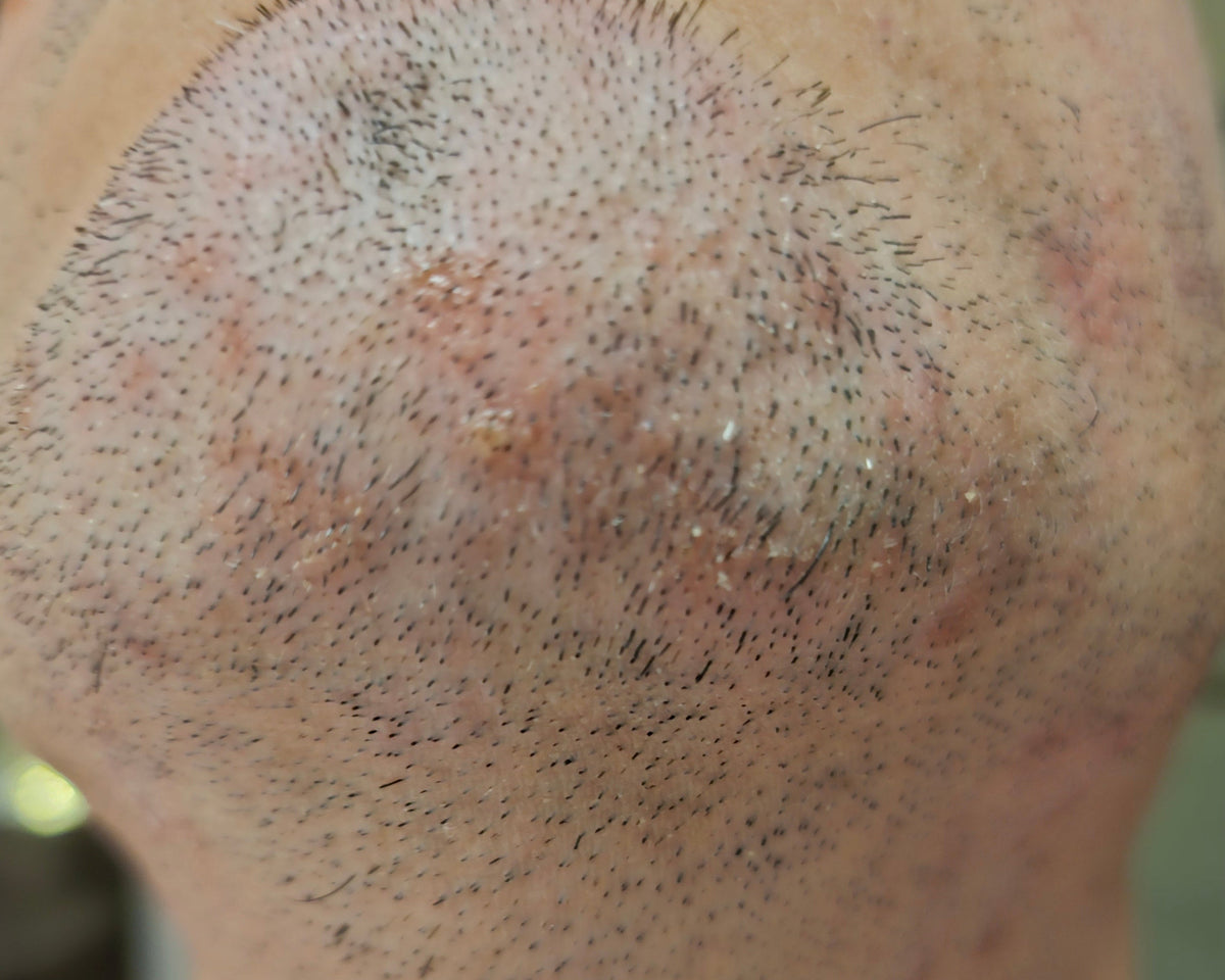 Seborrheic Dermatitis on Face: Why It Keeps Coming Back