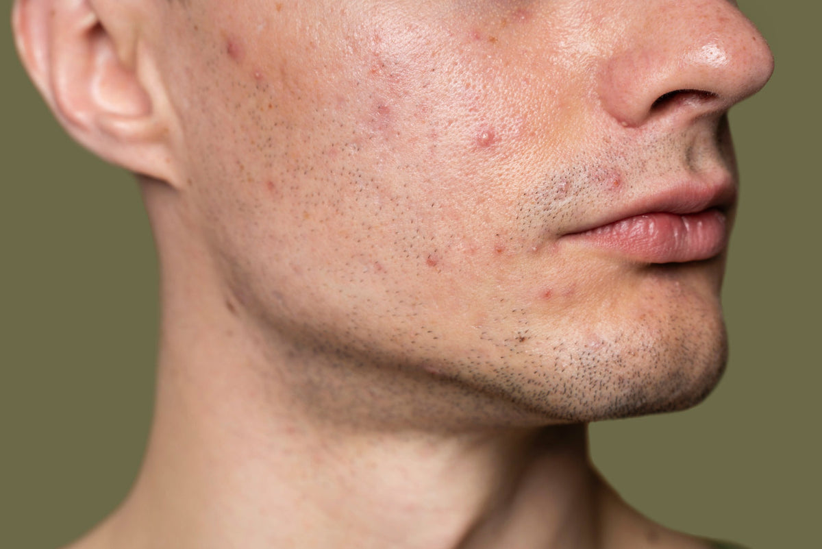 Fungal Acne: What It Is, Why It Keeps Coming Back and How to Treat It