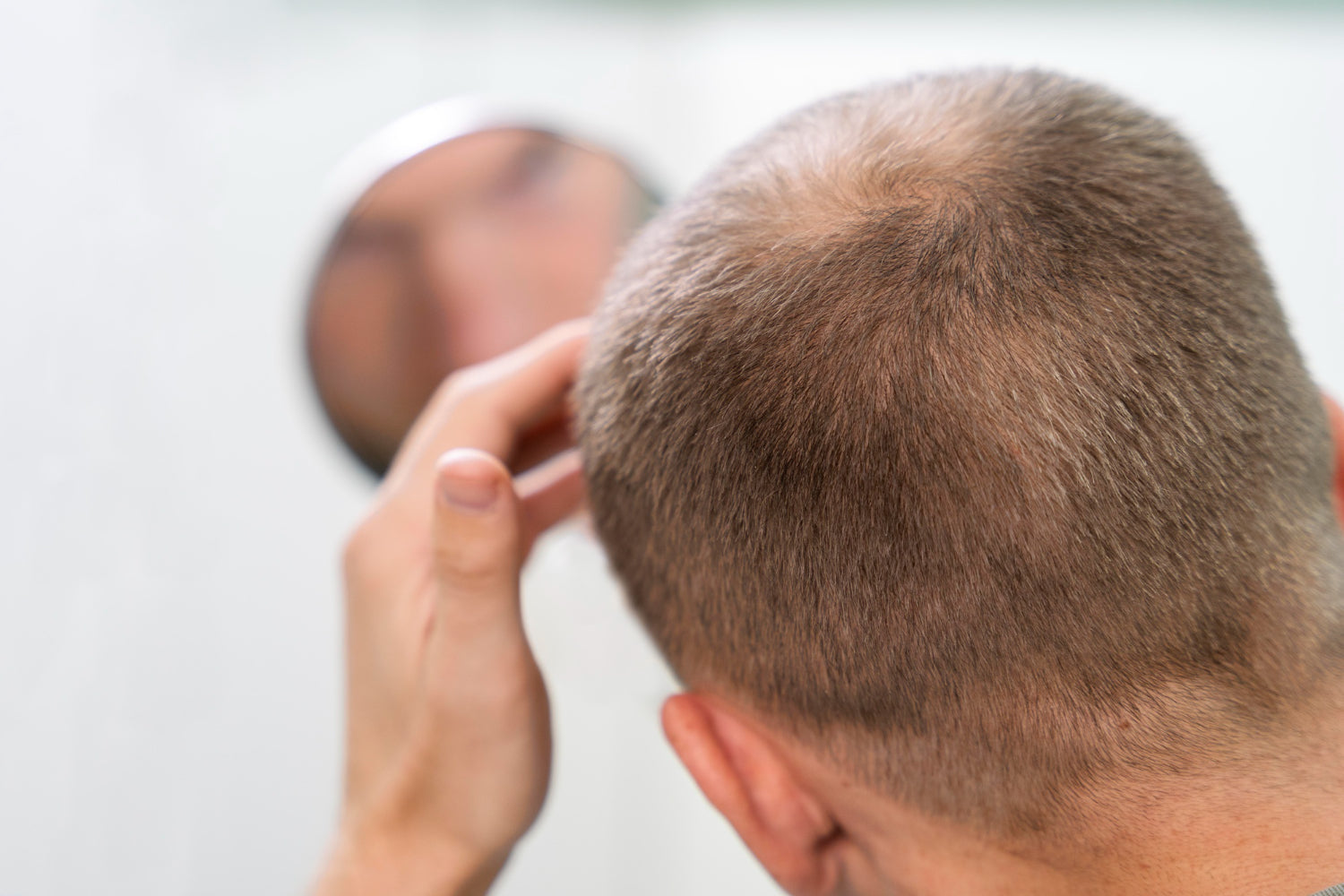 Does Seborrheic Dermatitis Cause Hair Loss?
