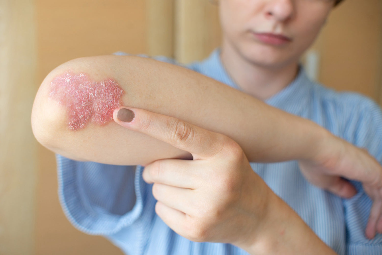 Seborrheic Dermatitis vs Psoriasis: How to Tell Them Apart