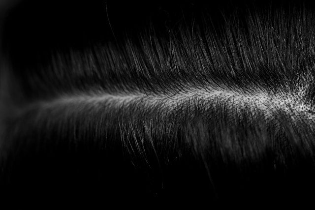 Differences Between Common Dandruff and Seborrheic Dermatitis on the Scalp