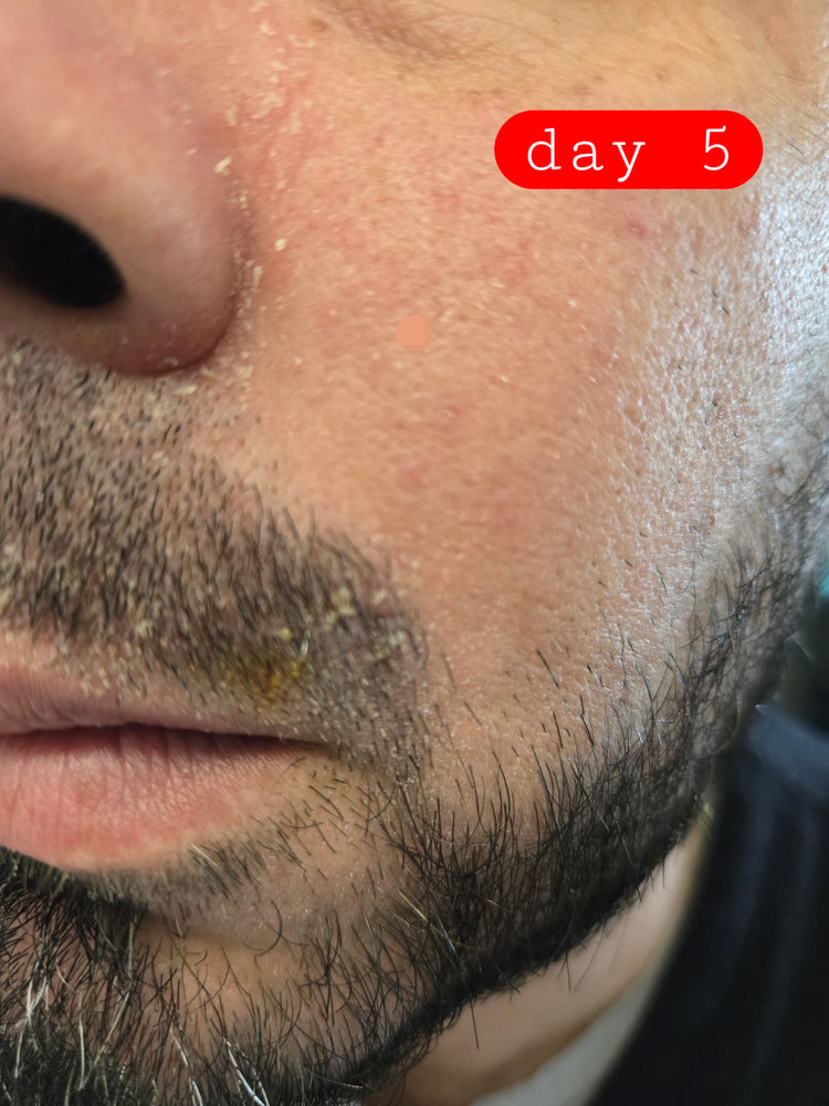 AFTER: cheek even-toned and rosacea under control with Epicderma