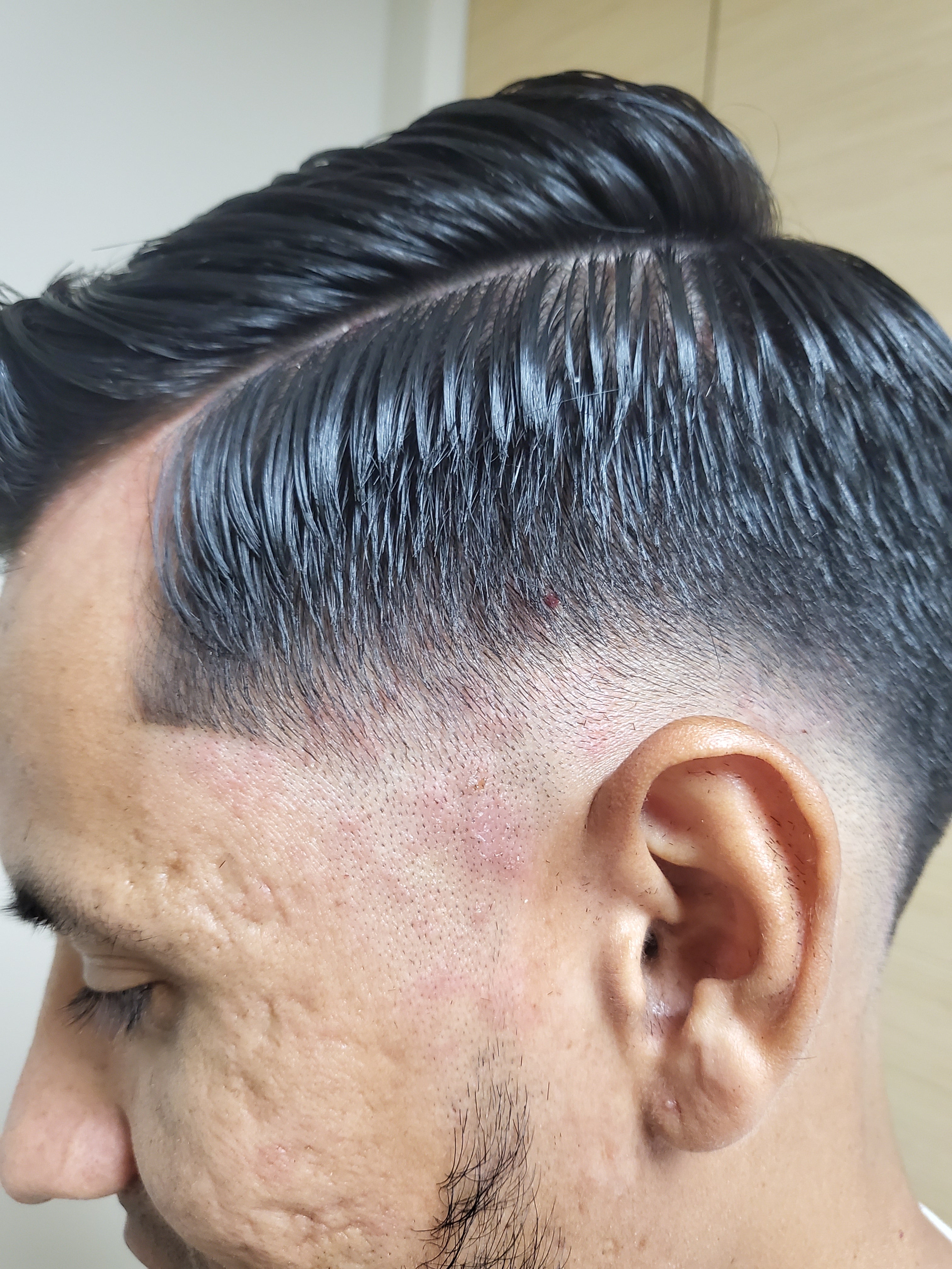 BEFORE: side hairline with seborrheic dermatitis flakes before Epicderma treatment