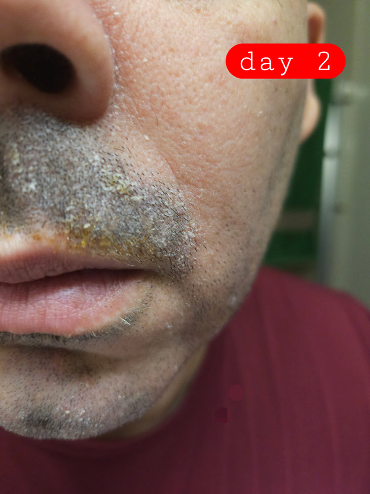 PROGRESS: facial redness visibly reduced mid-treatment with Epicderma