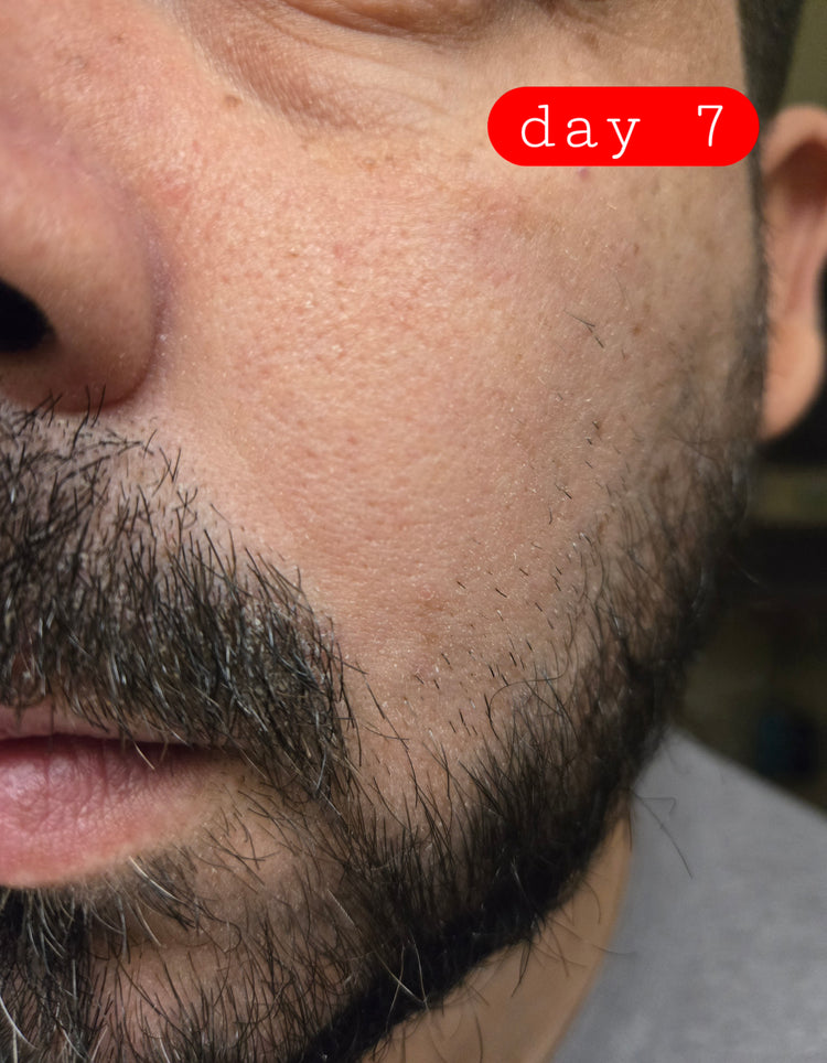 PROGRESS: nasolabial fold calmer with less itching after Epicderma