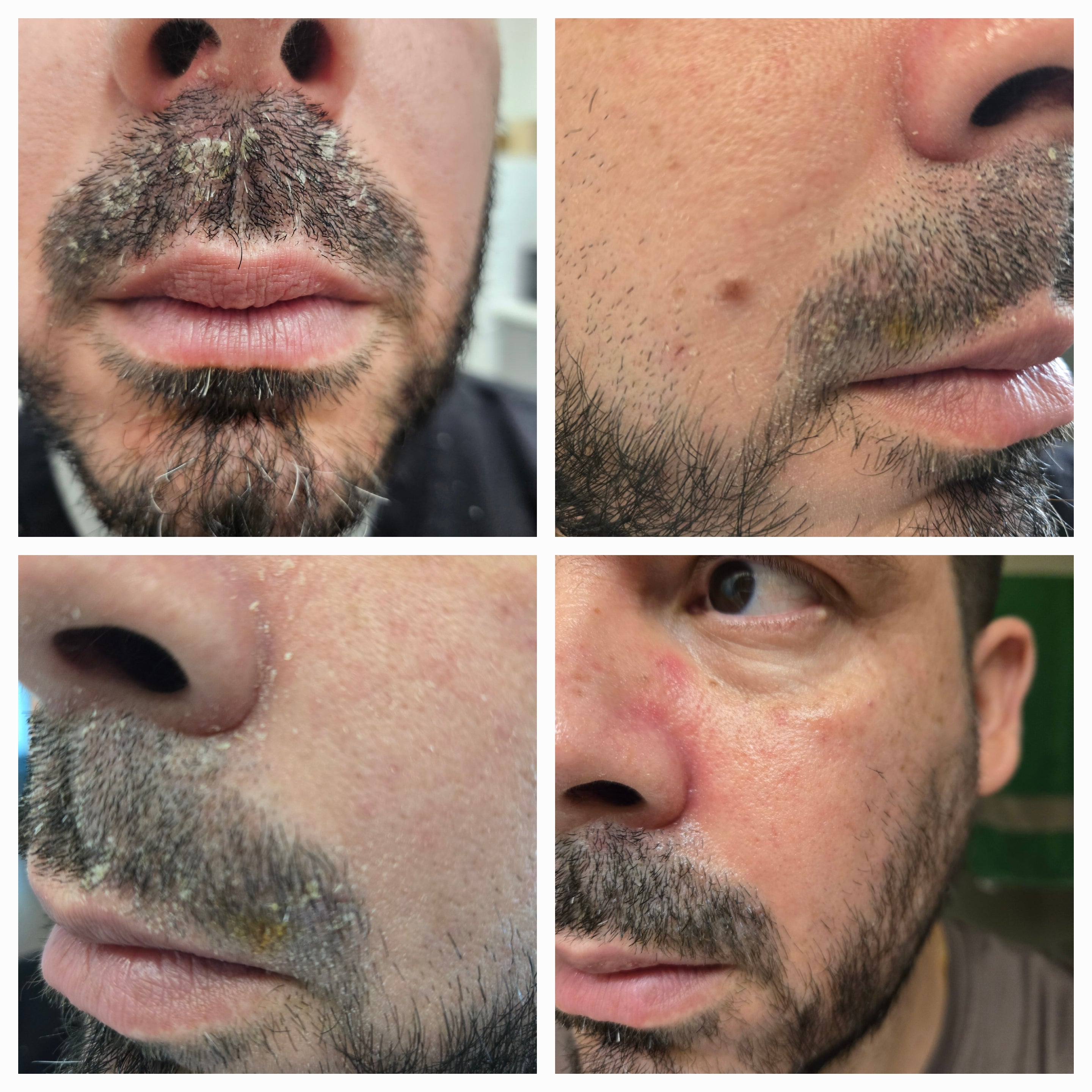 Real patient showing signs and symptoms of seborrheic dermatitis on different zones of the skin. Before imagery.